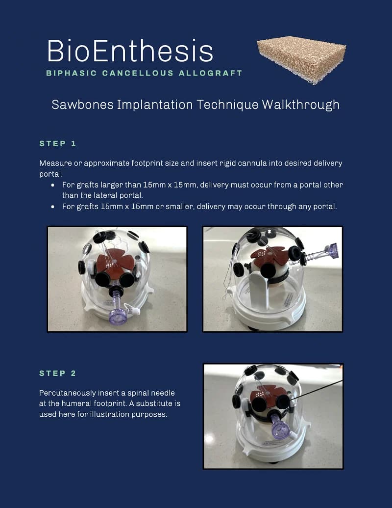 Sawbones Implantation Technique Walkthrough PDF for download