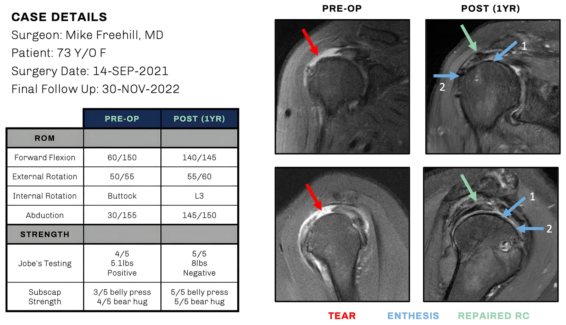 Reported and positive PRO and MRI results illustration